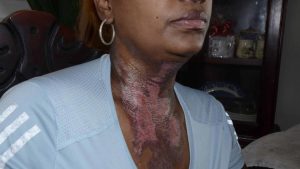 Mujer denuncia esta abanonada por autoridades luego que su ex pareja intentara matarla